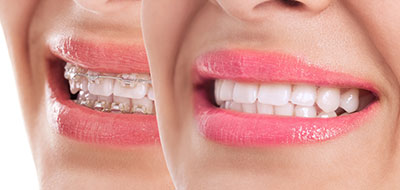 Orthodontic Braces 47401