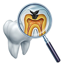 Tooth Decay Dentist Bloomington