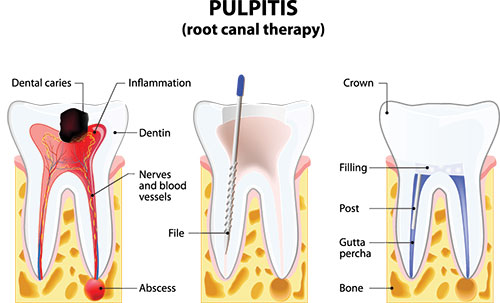 Root Canal in Bloomington